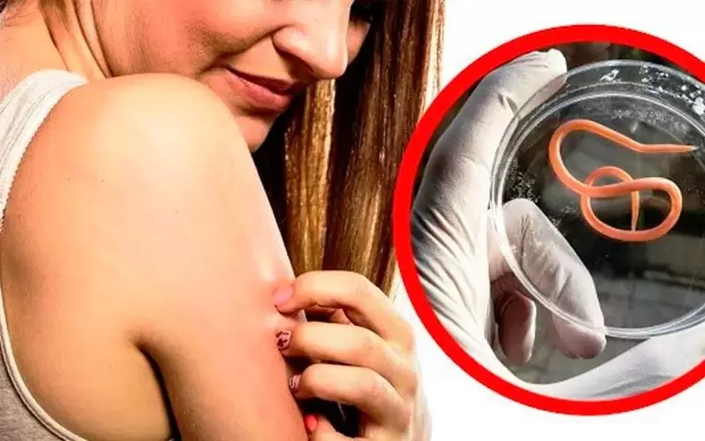 srbenje in draženje zaradi parazitov v telesu