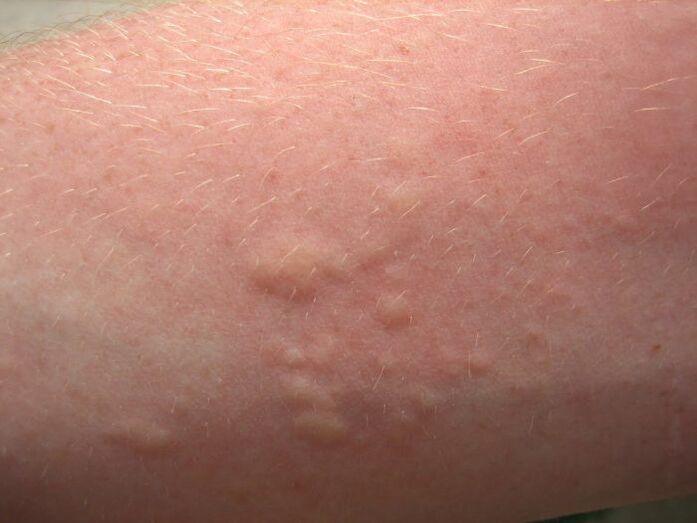srbeči alergijski kožni izpuščaji so lahko simptomi ascariasis