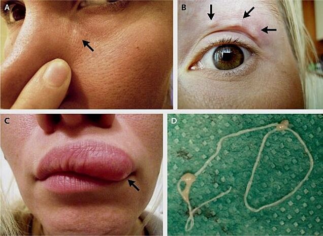 Glavne manifestacije dirofilarioze na obrazu