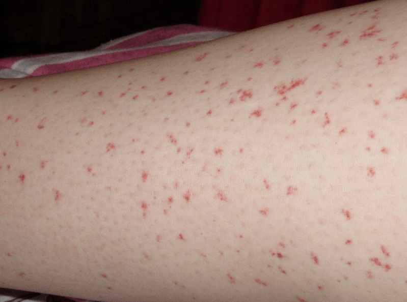 Kožni izpuščaj je znak akutne faze okužbe s črvi